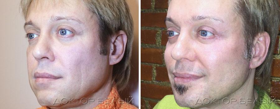 результаты лифтинга лица для мужчин. фото до и после операции