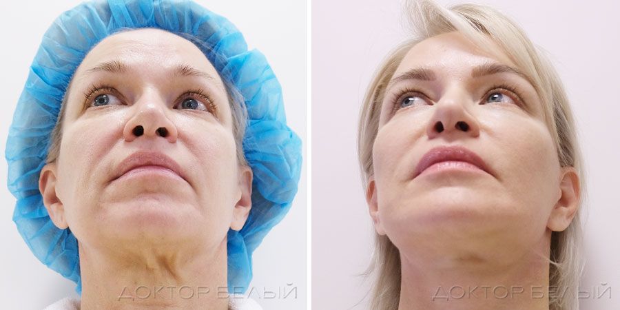 Фото пластики лица до и после операции 3S-лифтинг через 3 месяца
