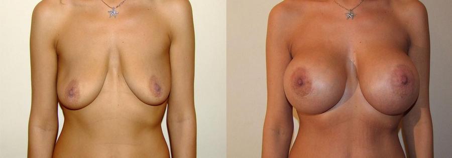 фото подтяжки груди до и после операции