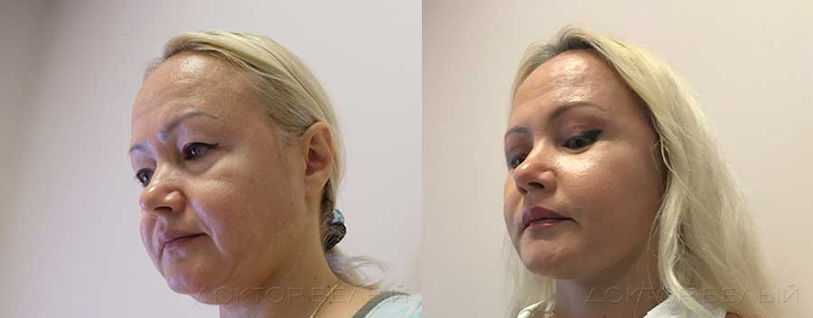 Фото до и после хирургической подтяжки лица. В дополнение к подтяжке СМАС была проведена подтяжка верхних век